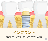 インプラント