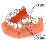 インプラント