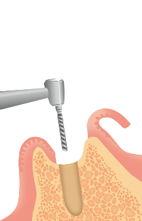 インプラント流れ