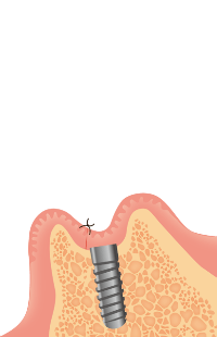 インプラント埋入